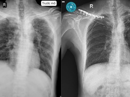 Nam bệnh nhân gãy cùng lúc hai xương đòn sau tai nạn giao thông