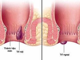 Chủ động phòng ngừa bệnh trĩ từ những thói quen nhỏ mỗi ngày