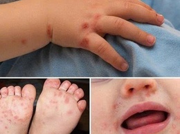 Bệnh tay chân miệng và các biện pháp phòng bệnh 
