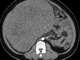 Chủ quan, e ngại không muốn đi khám người phụ nữ mang khối u sarcoma tử cung nặng gần 9kg