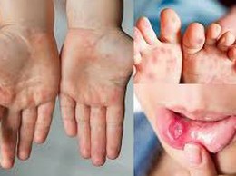 Xã Suối Hai tăng cường phòng, chống bệnh tay chân miệng và các bệnh truyền nhiễm