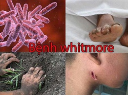 Những điều cần biết về bệnh Whitmore - Hiểu đúng để chủ động phòng bệnh