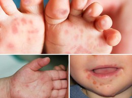 Cách phát hiện sớm trẻ mắc tay chân miệng