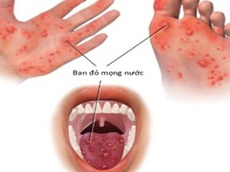 Hướng dẫn theo dõi và chăm sóc trẻ mắc tay chân miệng tại nhà