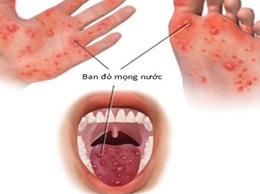 7 sai lầm nguy hiểm và cách phòng tay chân miệng