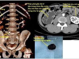 Bệnh viện Thận Hà Nội khuyến cáo không chủ quan với sỏi thận tiết niệu