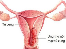 Cảnh giác với những bệnh lý ở phụ nữ sau mãn kinh