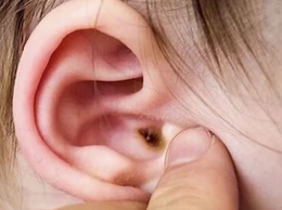 Đừng xem nhẹ viêm tai giữa cấp tính ở trẻ em