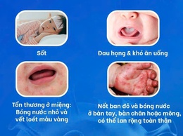 Chủ động nhận biết sớm bệnh tay chân miệng để bảo vệ trẻ nhỏ trước nguy cơ biến chứng nguy hiểm
