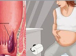 Khuyến cáo điều trị bệnh trĩ cấp ở phụ nữ mang thai và sau sinh: Ưu tiên bảo tồn, hạn chế can thiệp phẫu thuật