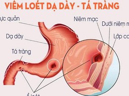 Đừng xem nhẹ viêm loét dạ dày - tá tràng ở trẻ vị thành niên