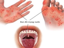 Những điều cần biết về bệnh tay chân miệng: Trẻ mắc nhiều lần có nguy hiểm không?