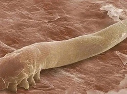 Demodex trên da - Nguyên nhân gây viêm da, kích ứng kéo dài