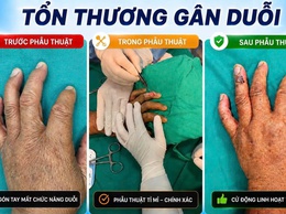 Bệnh viện đa khoa Hòe Nhai: Phẫu thuật phục hồi chức năng duỗi ngón tay thành công cho người bệnh tổn thương gân duỗi