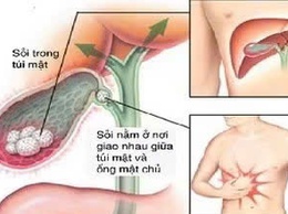 Chủ động theo dõi để phòng ngừa biến chứng sau phẫu thuật sỏi mật