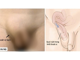 Thoát vị bẹn ở trẻ: 3 dấu hiệu cần đưa trẻ đi khám sớm