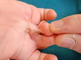 Bỏng nhiệt ở trẻ em và cách xử trí đúng cách