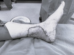 BVĐK Hòe Nhai: Xử trí thành công ca bệnh vết thương lóc da phức tạp vùng cổ gót chân