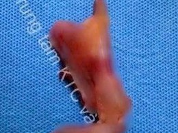U nhầy ruột thừa: Mối nguy âm thầm không nên xem nhẹ