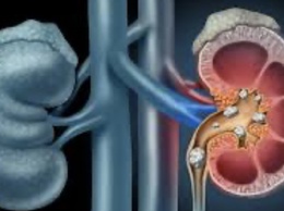 Chữa sỏi thận tại nhà bằng thuốc nam: Coi chừng biến chứng nguy hiểm