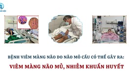 Bệnh viêm màng não do não mô cầu