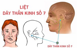 BVĐK Hòe Nhai: Cảnh báo liệt dây thần kinh số VII
