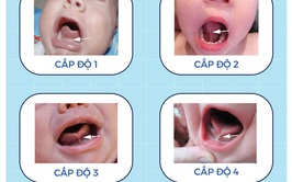 Dính thắng lưỡi ở trẻ cần được quan tâm ngay từ giai đoạn sơ sinh để không bỏ lỡ thời điểm vàng