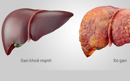 BVĐK Đống Đa cứu sống bệnh nhân mắc xơ gan mất bù nguy kịch