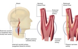 Cảnh báo hẹp động mạch cảnh - sát thủ thầm lặng gây nhồi máu não