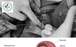 BVĐK Chương Mỹ phẫu thuật thành công ca chuyển dạ đặc biệt