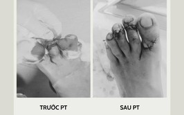 Phẫu thuật cấp cứu ca chấn thương do tai nạn lao động