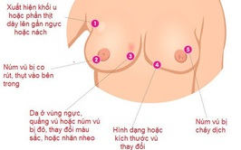 Tầm soát và chẩn đoán sớm ung thư vú giúp nâng cao hiệu quả điều trị