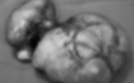 BVĐK Đông Anh phẫu thuật thành công cho bệnh nhân u xơ tử cung thoái hoá nhầy khổng lồ