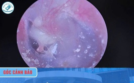 Cholesteatoma tai giữa ở trẻ em: Phát hiện sớm, điều trị kịp thời để tránh biến chứng