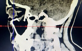 Cấp cứu kịp thời ca chấn thương hàm mặt phức tạp, phục hồi thị lực cho người bệnh