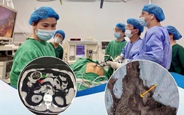 Đừng chủ quan với cơn đau bụng kéo dài: cảnh báo từ ca lâm sàng lồng ruột hiếm gặp