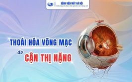Thoái hóa võng mạc do cận thị nặng, tiềm ẩn nguy cơ gây mất thị lực