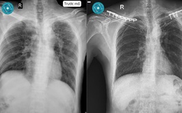 Nam bệnh nhân gãy cùng lúc hai xương đòn sau tai nạn giao thông