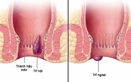 Chủ động phòng ngừa bệnh trĩ từ những thói quen nhỏ mỗi ngày