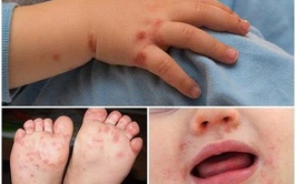 Bệnh tay chân miệng và các biện pháp phòng bệnh 
