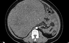 Chủ quan, e ngại không muốn đi khám người phụ nữ mang khối u sarcoma tử cung nặng gần 9kg
