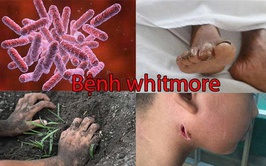 Những điều cần biết về bệnh Whitmore - Hiểu đúng để chủ động phòng bệnh