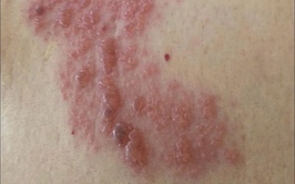 Zona thần kinh- đừng chủ quan với cơn đau âm ỉ kéo dài