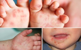 Cách phát hiện sớm trẻ mắc tay chân miệng