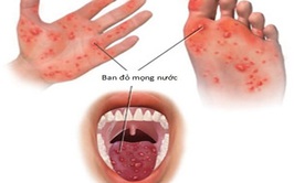 Hướng dẫn theo dõi và chăm sóc trẻ mắc tay chân miệng tại nhà