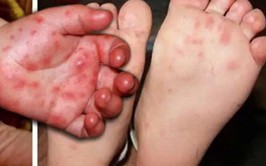 Tổ chức đợt cao điểm “Vệ sinh môi trường, khử khuẩn chủ động phòng, chống bệnh Tay chân miệng” trên địa bàn xã đợt tháng 3, 4 năm 2026