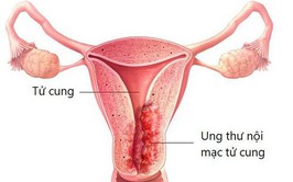 Cảnh giác với những bệnh lý ở phụ nữ sau mãn kinh