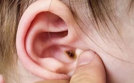 Đừng xem nhẹ viêm tai giữa cấp tính ở trẻ em