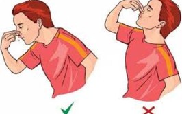 Cần xử trí chảy máu cam đúng cách để tránh biến chứng