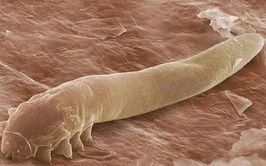 Demodex trên da - Nguyên nhân gây viêm da, kích ứng kéo dài